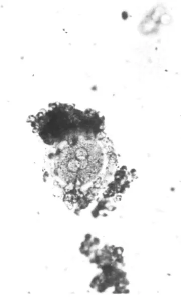 Fig. 1. Fertilized oocyte with three pronuclei.
