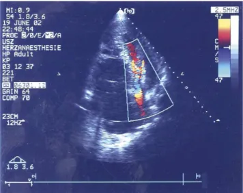 Fig. 2. Trans thoracic echocardiography (during VF) shows accelerated flow through compressed left ventricle with dilated right ventricle.