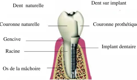 Fig. II.3 : prothèse dentaire en coupe [21]. 