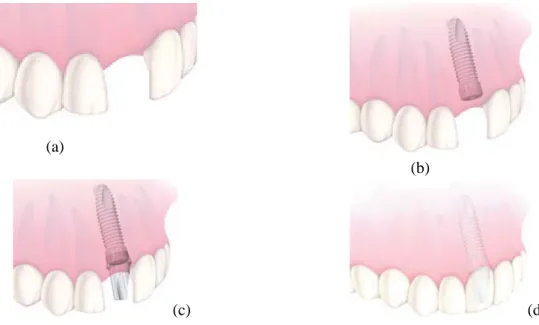 Fig. II.8 : Etapes de traitement de remplacement d’une seule dent [21]. 