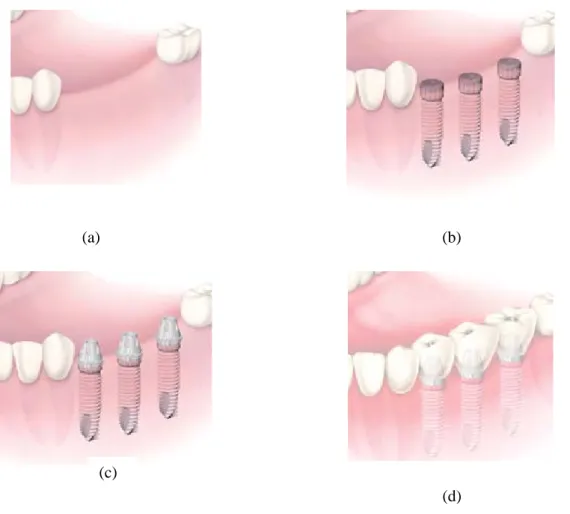 Fig. II.11 : Etapes de traitements de remplacement de plusieurs dents [21]. 