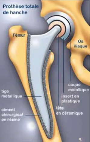 Figure 1.2 : Prothèse totale de hanche cimentée  5