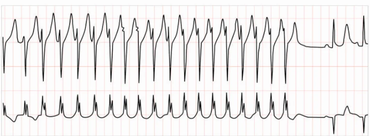 Figure 1.13. Tachycardie sinusale. Le rythme est de 120 bpm.