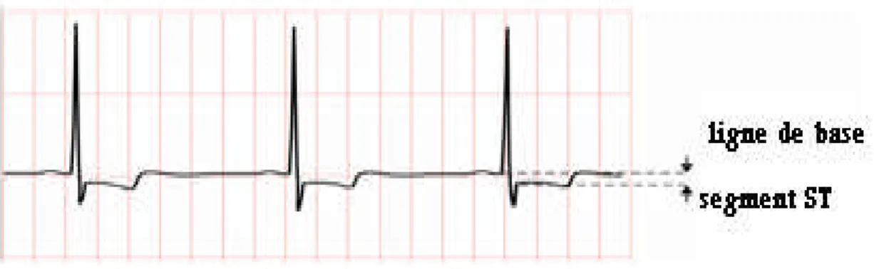 Figure 1.20. Ischémie conséquence d’un petit infarctus.
