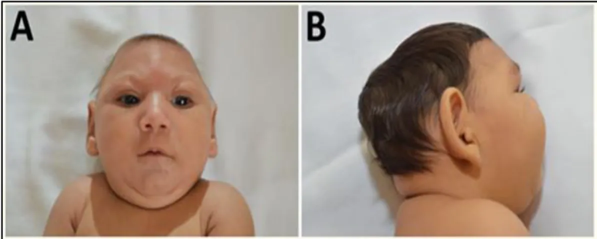 Figure 4. Characteristic phenotype of fetal brain disruption sequence in infants with probable  congenital  ZIKV  syndrome:  A)  craniofacial  disproportion  and  biparietal  depression,  B)  prominent occiput (Moura da Saliva et al., 2016)