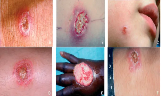 Figure 24. Diagnostics différentiels de leishmaniose cutanée localisée ulcérée. 