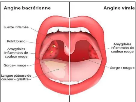 Figure 10 Caractéristique d'une angine bactérienne et une angine virale [27]. 