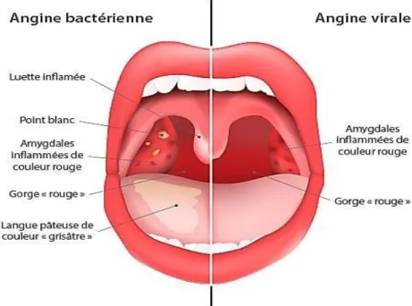 Figure 10 Caractéristique d'une angine bactérienne et une angine virale [27]. 