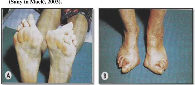 Fig. 9:Atteintes des pieds chez les patients atteints de PR (griffe des orteils)   (Sany in Maclé, 2012)