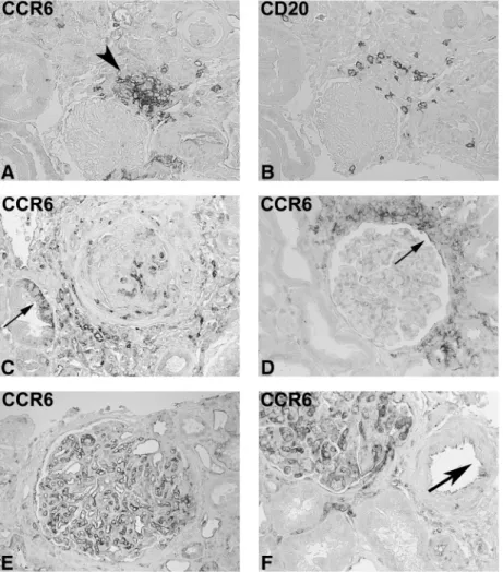 Fig. 3. CCR6 expression in renal biopsies from patients with IgA nephropathy and membranous nephropathy