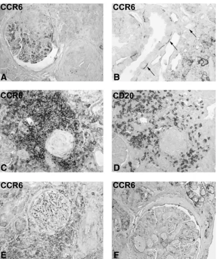 Fig. 4. CCR6 expression in biopsies with crescentic GN and chronic interstitial nephritis