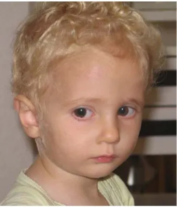 Figure 3. Photograph of patient 1 aged 4 years.