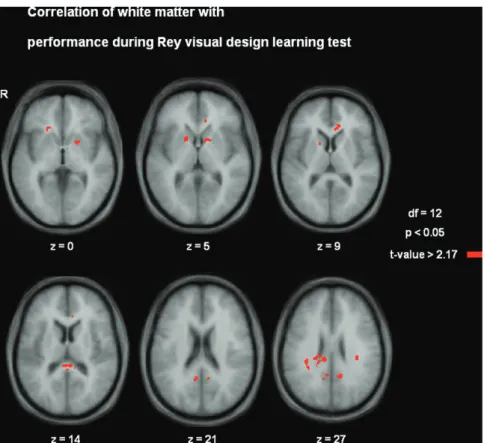 Fig. 2. Axial slices of a representative subject showing the locations of statistically significant correlations of white matter with performance (p , 0.05)