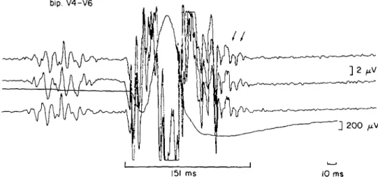 Figure 2 Signal-averaged electrocardiogram obtained in a 38-year-old patient with idiopathic dilated cardiomyopathy, no bundle branch block but documented episodes of sustained ventricular tachycardia.