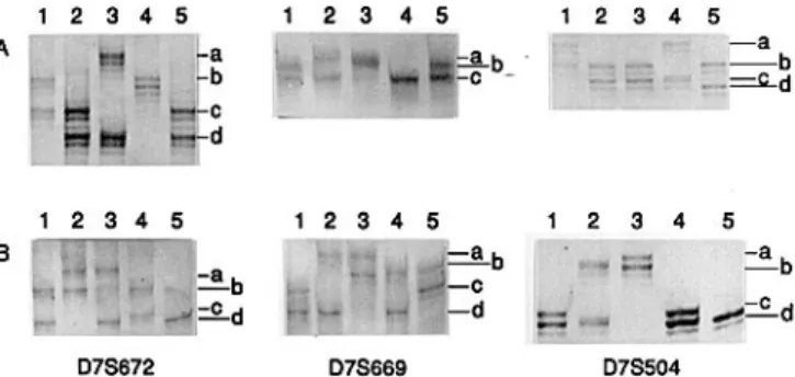 Figure 2. Results for the microsatellite loci D7S672, D7S669 and D7S504 in Family 5 (A) and Family 82 (B)