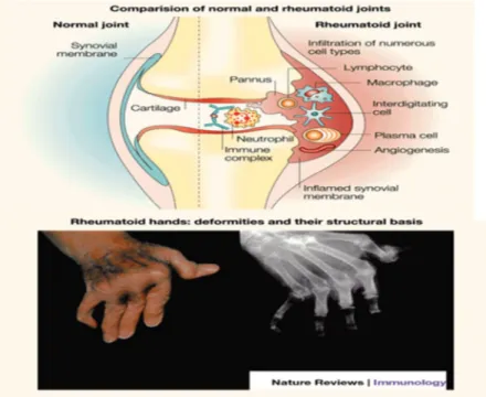 Fig 7: La polyarthrite rhumatoïde 