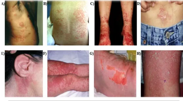 Figure 2 : Les différentes formes cliniques d’atteinte cutanée allergique (Pichler, 2017)