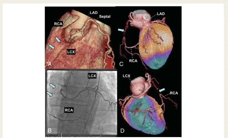 Figure 2 Fifty-four-year-old patient with a congenital coronary anomaly consisting of a common origin of all four coronary arteries (left anterior descending, septal branch (septal), right coronary artery, and left circumfley artery) from the right coronar