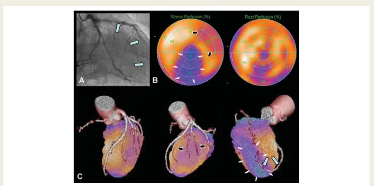 Figure 5 Eighty-six-year-old patient with increasing angina at rest. The invasive coronary angiography (A) demonstrates a left dominance with severely calcified vessels