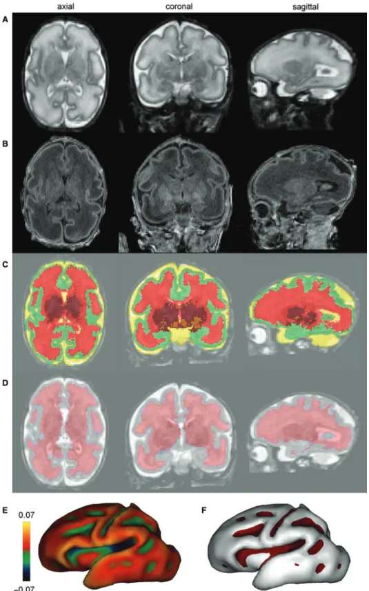Fig. 1 Volumetric and surfacic identification at birth: Using T 2 - and T 1 -weighted MR images (A and B), post-processing enabled the classification of cerebral tissues for volumetric measurements [(C) green: cortex, red: unmyelinated white matter, orange