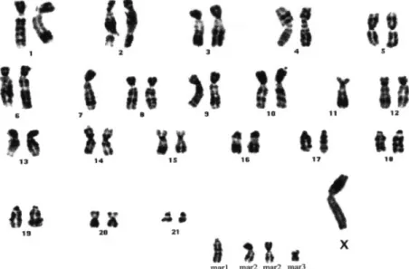 Fig. 9. The chromosomal pattern of KL5B at stage 27 showing 45, X, –Y, –7, –11, 1 mar1, 1 mar2 3 2, 1 mar3.