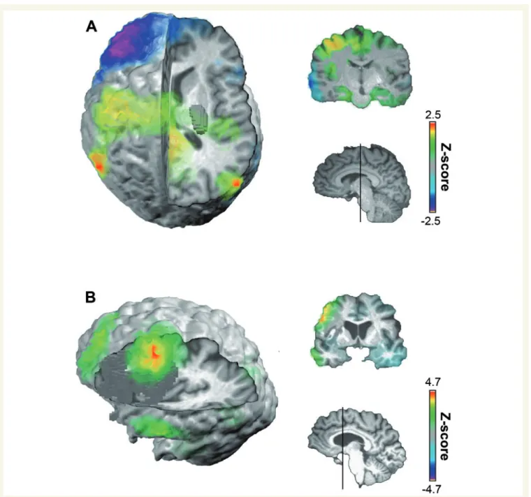Figure 1 Examples of hyperconnectivity after stroke resulting in increased WND in contralesional (A) and ipsilesional (B) hemispheres