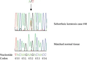 Figure 4. Example of a somatic FGFR3 mutation in a seborrheic keratosis sample. Sequencing revealed a missense mutation in codon 652 (AAG– 
