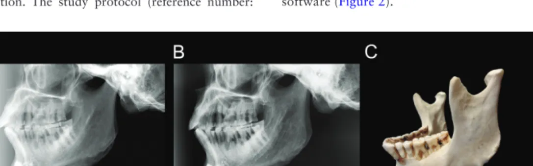 Figure 1.  A letter ‘L’ was placed on the image close to the angle of the mandible to indicate the left side