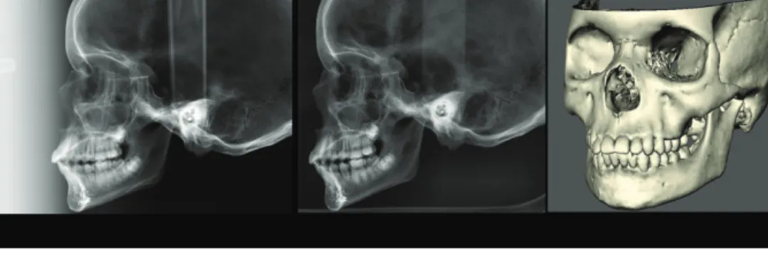 Figure 2.  Examples of images from all radiographic devices used in the present study: (A) lateral cephalogram from a cephalometric device with 1.5 m source- source-to-mid-sagittal-plane distance (SMD) with a visible ruler that was used for image calibrati