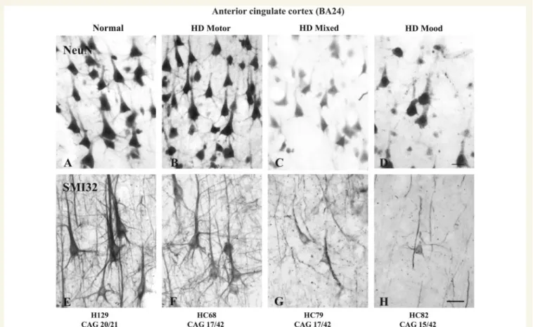 Figure 6 Photomicrographs illustrating the pyramidal neurons in layer III in Brodmann area 24 of the anterior cingulate cortex of control (A and E) and Huntington’s disease (B–D, F–H) cases (HD) with ‘mainly motor’ (B and F), ‘mixed’ (motor–mood) (C and G)
