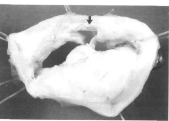 Figure 1 Excised mitral valve specimen. View is from the atrial side. Note the large tear in the posterolateral leaflet