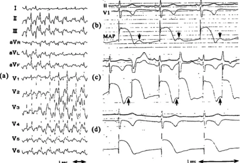 Figure 1 (a) Twelve-lead electrocardiogram during bidirectional VT. There is an alternating pattern of right and left bundle branch block (R/LBBB), or an alternating left and right axis deviation with an RBBB or LBBB pattern