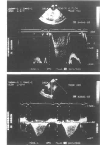 Figure 2 Left panel.(from top to bottom): reconstruction of the left ventricular pressure measurements from the digitized apical and basal zone tracings (see Fig