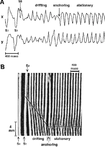 Fig. 12. Anchoring of a drifting spiral wave. A Electrocardiographic recordings showing that premature stimulation S 2 produced polymorphic arrhythmic activity followed by a transition to sustained monomorphic tachycardia