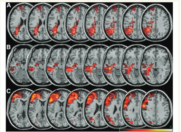 Figure 5 Anatomical correlates of the three neglect components identified by the factorial analysis and submitted to VLSM analysis