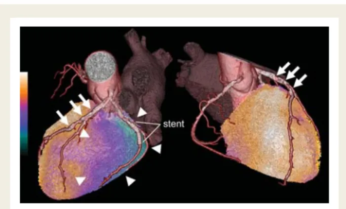 Figure 1 Fused stress 99m Tc-tetrofosmin perfusion single- single-photon emission computed tomography/computed tomography coronary angiography image (radiation dose from computed  tom-ography coronary angitom-ography 2.2 mSv, from stress-single-photon emis