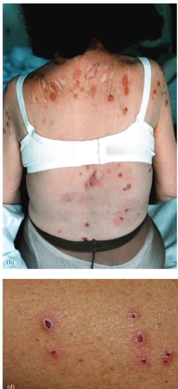 Fig. 1. (a–d) Skin affected in patients with uraemic pruritus. (a) Scratches on the arm hosting the fistula