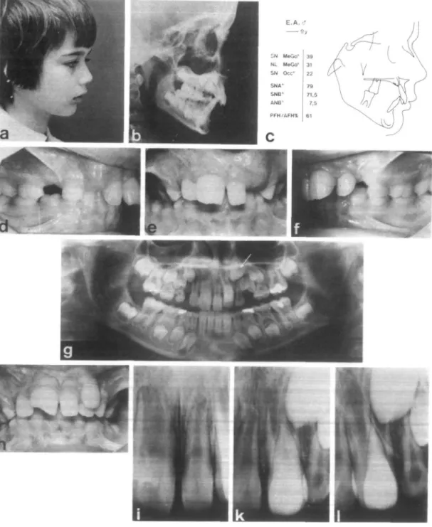 Figure 1 Pretreatment records, a-f: class II, div. 1, deep overbite, tooth size discrepancies, g: the left upper central is a supernumerary tooth, two left laterals are erupting and the left upper canine is developing in a  pro-nounced mesial direction, h: