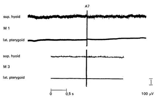 Figure 11  M l and M 3: The activator is in place. A7 shows a decreasing activity of the suprahyoid muscles from M 1 to M 3, and complete inactivity of the lateral pterygoid muscle.