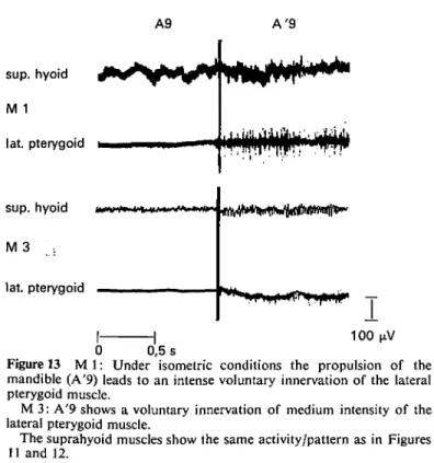 Figure 13  M l : Under isometric conditions the propulsion of the mandible (A'9) leads to an intense voluntary innervation of the lateral pterygoid muscle.