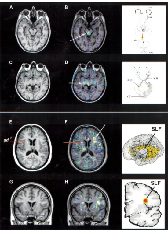 Fig. 7 Focal [ 11 C](R)-PK11195 binding. (A and B) A focus of elevated [ 11 C](R)-PK11195 binding (arrow) in the brainstem co-localizing with the medial longitudinal fasciculus (MLF) is seen in this patient (Patient 9), who was suffering from internuclear 