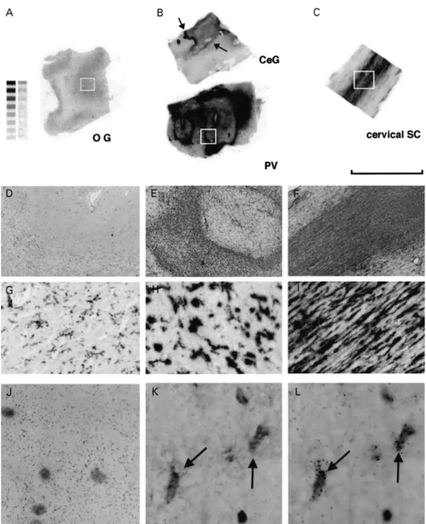 Fig. 3 [ 3 H](R)-PK11195 binding in multiple sclerosis: combined high-resolution autoradiography and immunohistochemistry