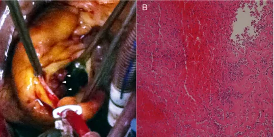 Figure 2: (A) After aortotomy, friable material protruding from the right coronary artery into the right coronary cusp of the sinus of Valsalva (arrowheads) was removed with no adherence
