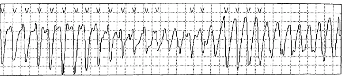 Fig. 1.  Electrocardiogram  demonstrating torsade de pointes.  It  is  readily apparent  that a  long pause  precedes the sinus beat  which  triggers  a  run  of polymorphic  ventricular  tachycardia