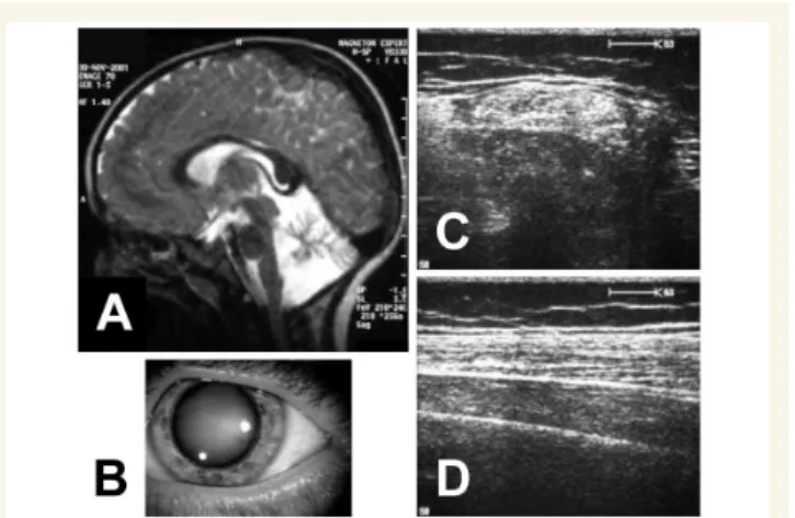 Figure 5 Patient MSS64.1 without intellectual disability but an otherwise characteristic Marinesco-Sjo¨gren syndrome  pheno-type