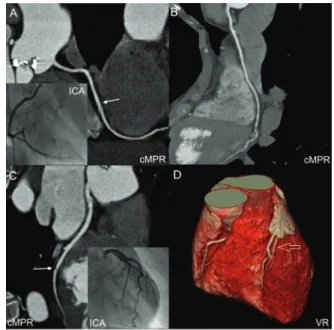 Figure 2. Sixty-four-slice CT coronary angiography and ICA in a 44-year-old man with atypical chest pain