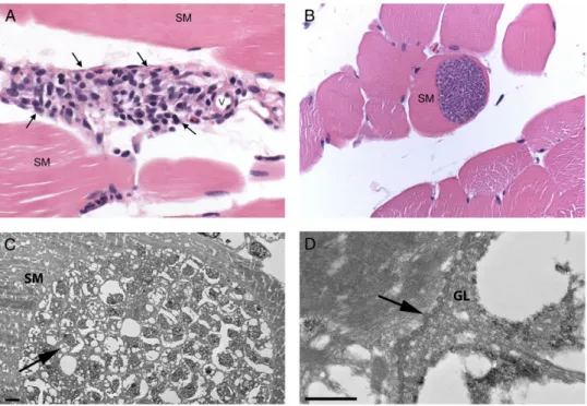 Figure 5. Histopathology and electron microscopy. A, Skeletal muscle (SM) with in ﬂ ammation (arrows) adjacent to a small vessel (v)