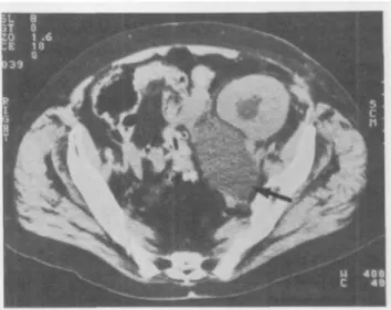 Fig. 1. Computed tomography showing lymphocele at the lower pole of the transplanted kidney (arrow) with dilatation of the renal pelvis.