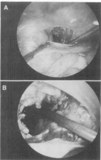 Fig. 2. Laparoscopic view: (a) opening of the lymphocele with the cautery hook; (b) fenestration of the lymphocele completed.