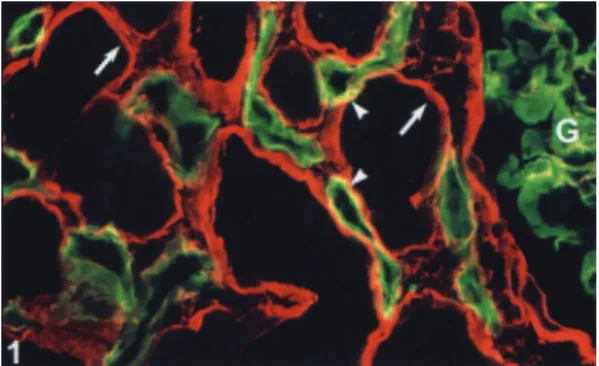 Fig. 1. Immunoﬂuorecence microscopy shows C4d deposits along peritubular capillaries (green, arrowheads) and collagen type IV accumulations along tubular basement membranes (red, arrows)